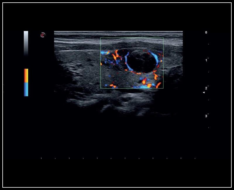 MyLab™Sigma - Thyroid lesion, imaging 2D with Color Doppler