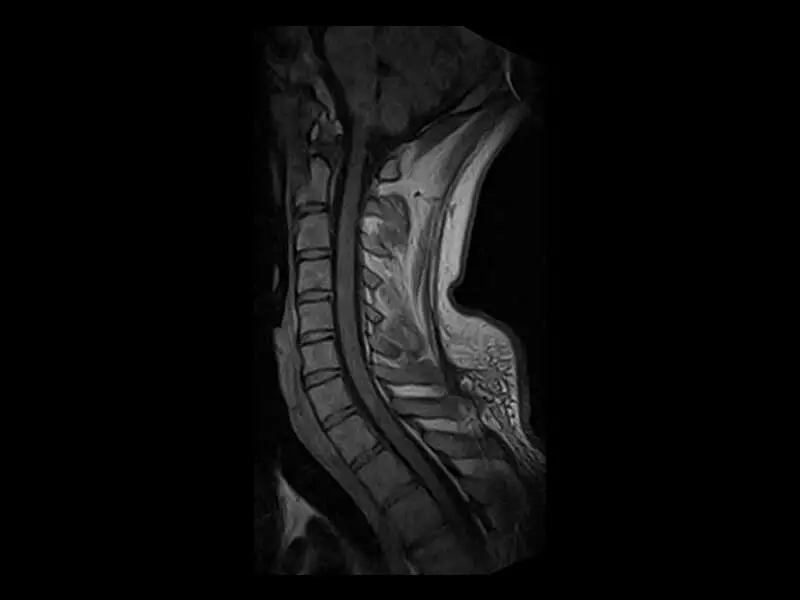 S-scan Open - Cervical Spine Echo Sagittal Exp