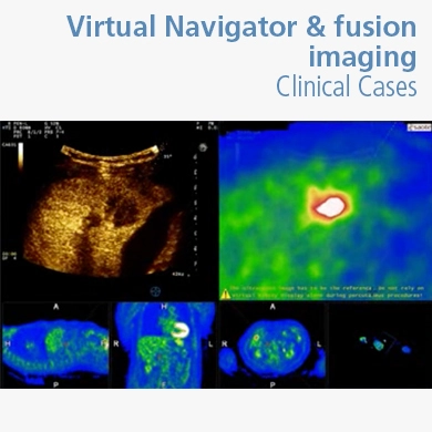 Virtual Navigator & fusion imaging - Clinical Cases