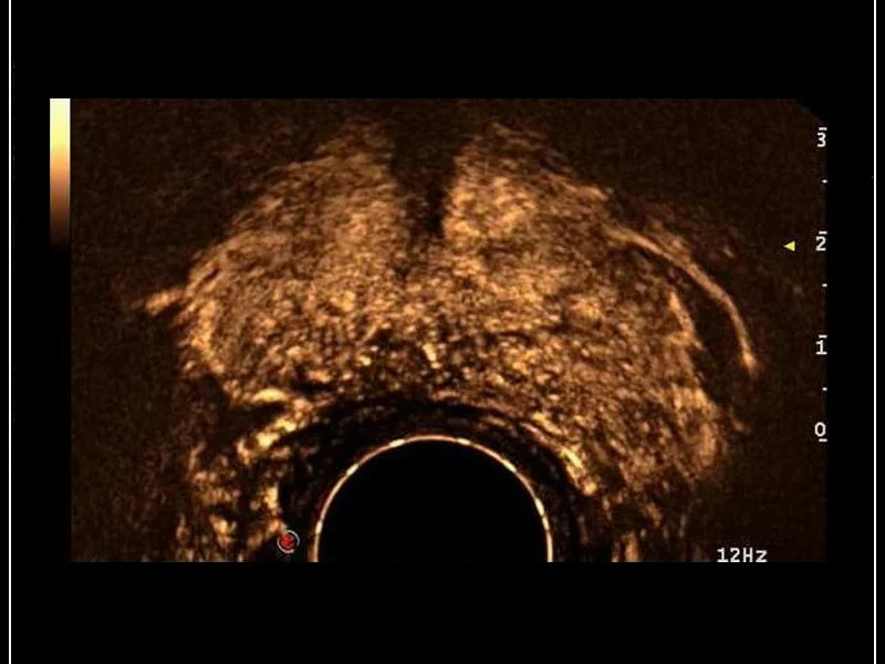 MyLab™9 Platform - Prostate contrast enhanced imaging (CnTI™)