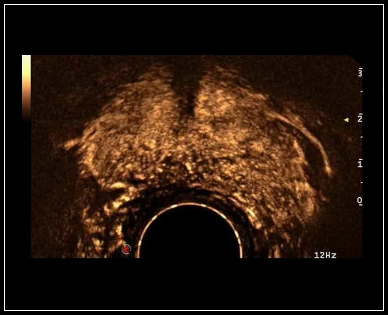 MyLab™9 Platform - Prostate contrast enhanced imaging (CnTI™)