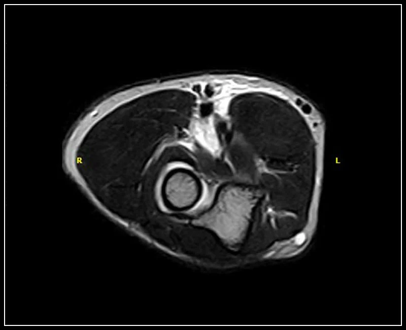 O-scan - Elbow - FSE T2 Axial