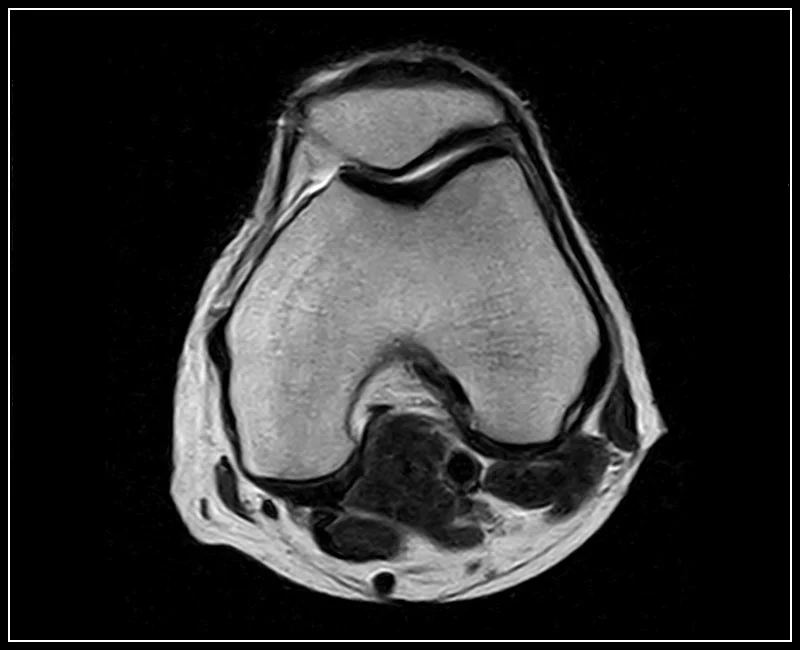 G-scan Brio - Knee - FSE T2 Axial