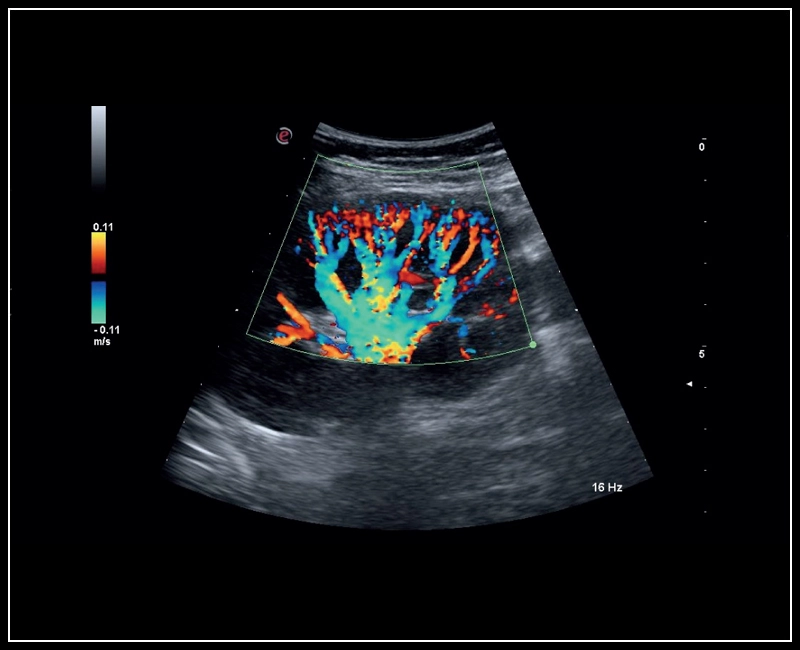 MyLab™Sigma - Kidney perfusion with high sensitivity Color Doppler mode