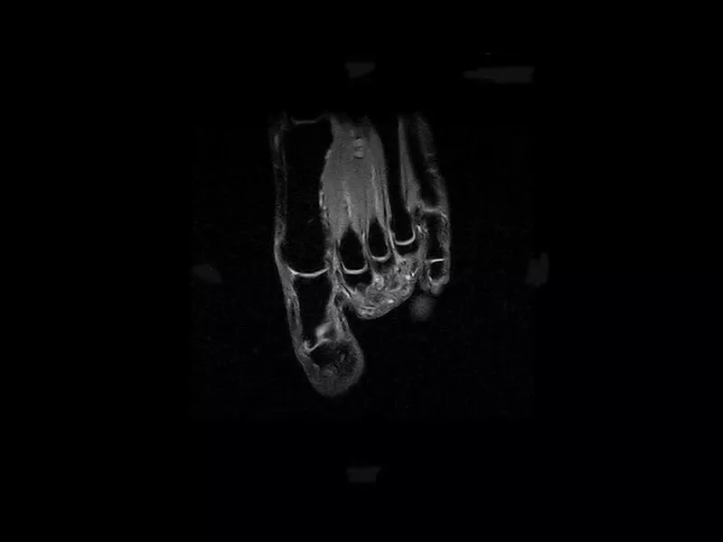 S-scan Open - Foot XBONE Coronal