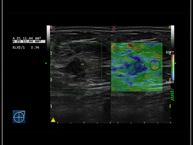 MyLab™9 Platform - Elastography advanced measurement package on breast lesion