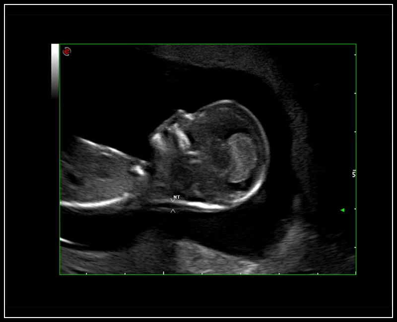 MyLab™9 Platform - HD Zoom on fetus profile with AutoNT measurement