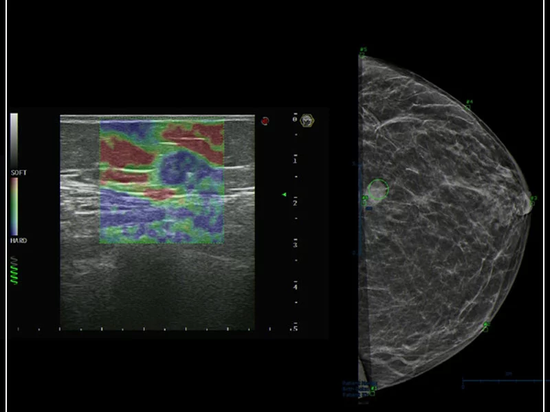 MyLab™9 Platform - Breast BodyMap and real-time ElaXto in Mammo