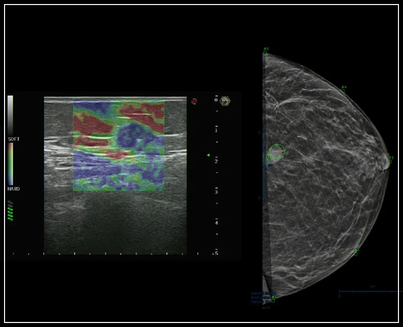 MyLab™9 Platform - Breast BodyMap and real-time ElaXto in Mammo