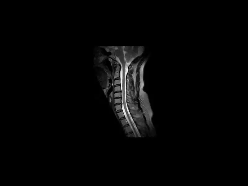 S-scan Open - Cervical Spine FSE T2 Axial