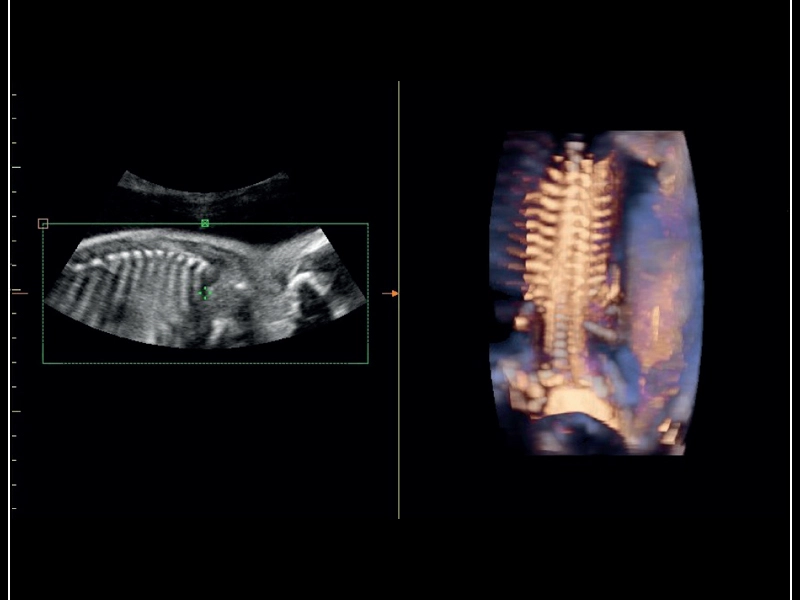 MyLab™Sigma - Semi transparent rendering of fetal spine