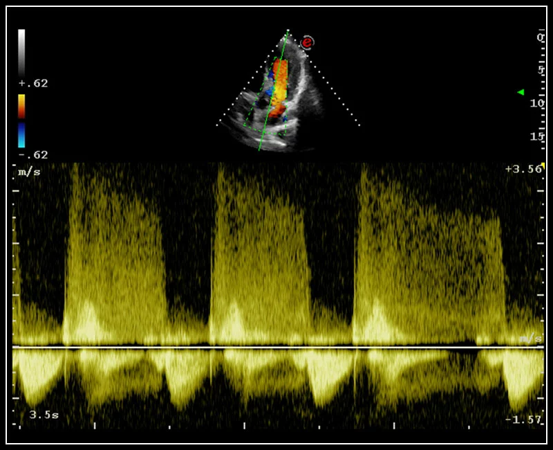 MyLab™9 Platform - Advanced CW Doppler processing chain for aortic stenosis quantification