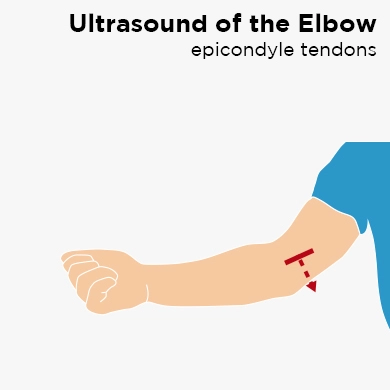 Ultrasound of the Elbow: Epicondyle tendons