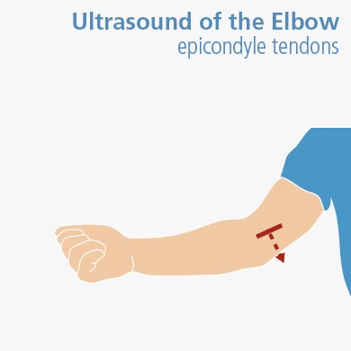 Ultrasound of the Elbow: Epicondyle tendons