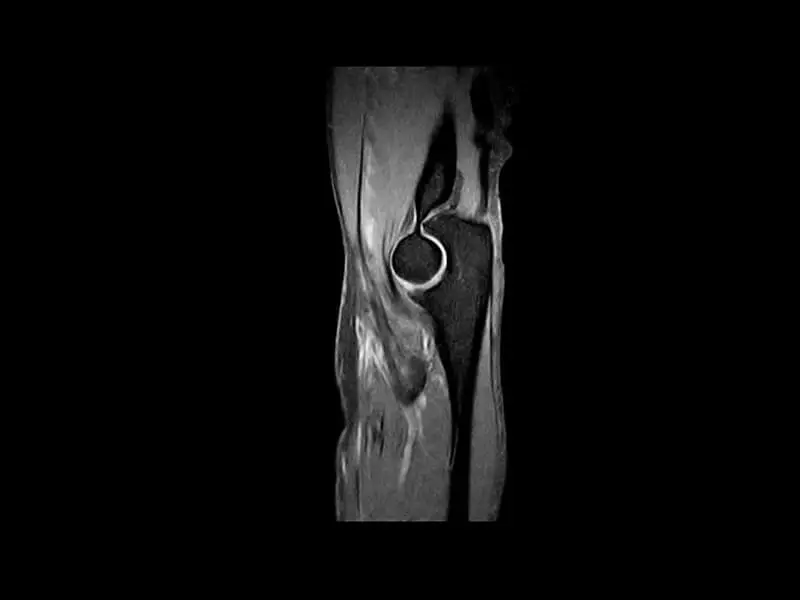 S-scan Open - Elbow SPED fat suppression sagittal