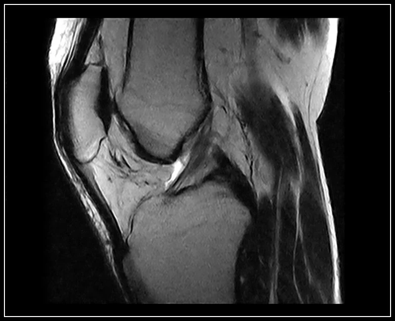 O-scan - Knee - FSE T2 Sagittal