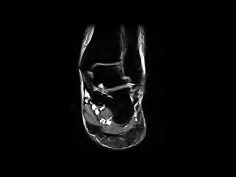 S-scan Open - Ankle FSTIR Coronal