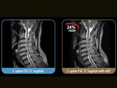 S-scan - C Spine FSE T2 Sagittal with eXP