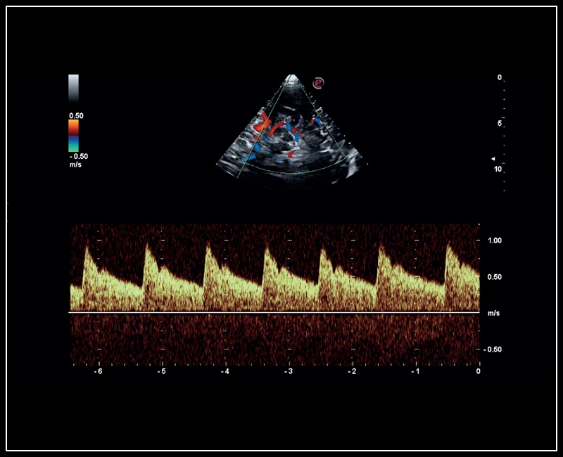 MyLab™Sigma - Mid cerebral artery investigation with PW Doppler mode