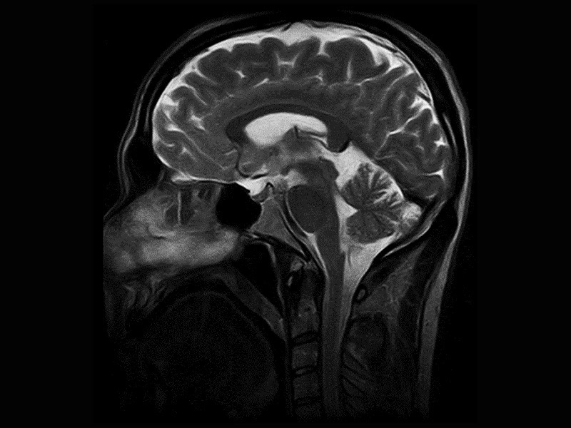 Magnifico™Open - Brain SET2 sagittal