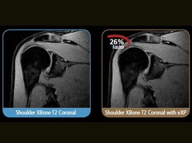 S-scan - Shoulder XBone T2 Coronal with eXP