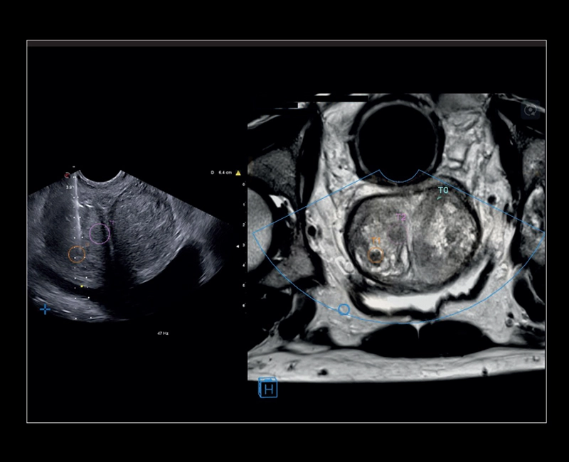 MyLab™X8 Platform - Prostate biopsy with Virtual Navigator fusion imaging 3D