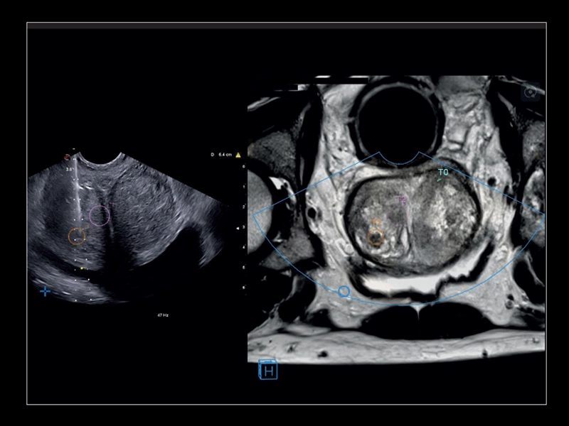 MyLab™X8 Platform - Prostate biopsy with Virtual Navigator fusion imaging 3D