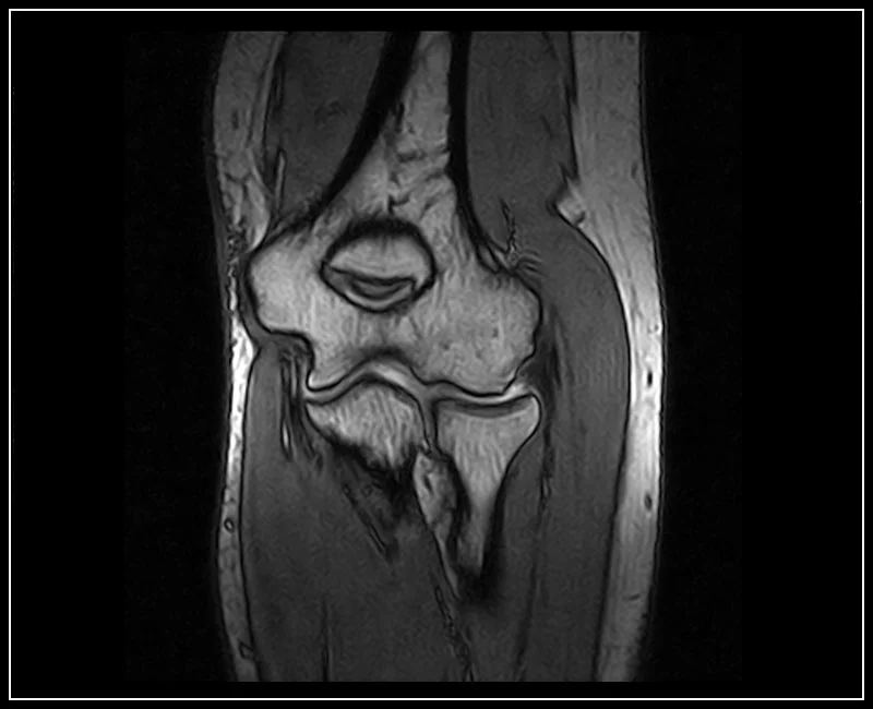 O-scan - Elbow - 3D Sharc Coronal