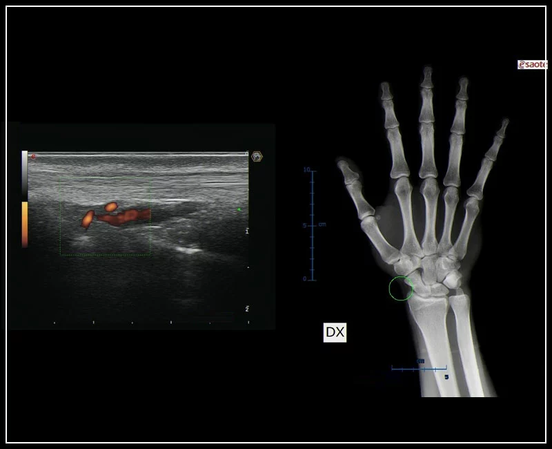 MyLab™9 Platform - MSK BodyMap and real-time XFlow on X-Ray extremities