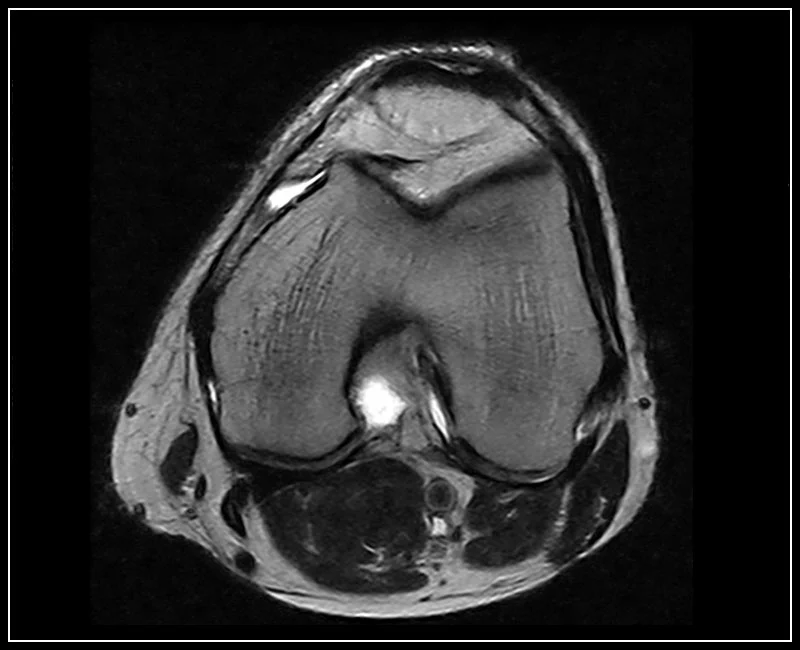 O-scan - Knee - FSE T2 Axial