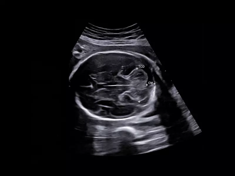MyLab™X90 - AutoOB Automatic proposals for fetal biometric measurements