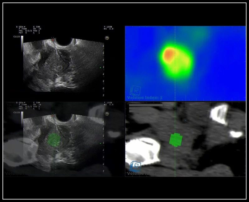 MyLab™9 Platform - Gynecology fusion imaging with PET for best lesion location