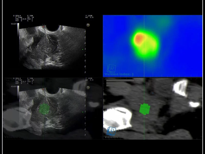 MyLab™9 Platform - Gynecology fusion imaging with PET for best lesion location