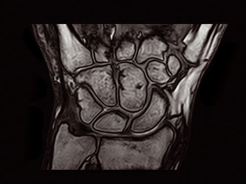 O-scan - Wrist 3D SHARC Coronal