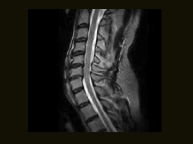 S-scan - C Spine FSE T2 Sagittal