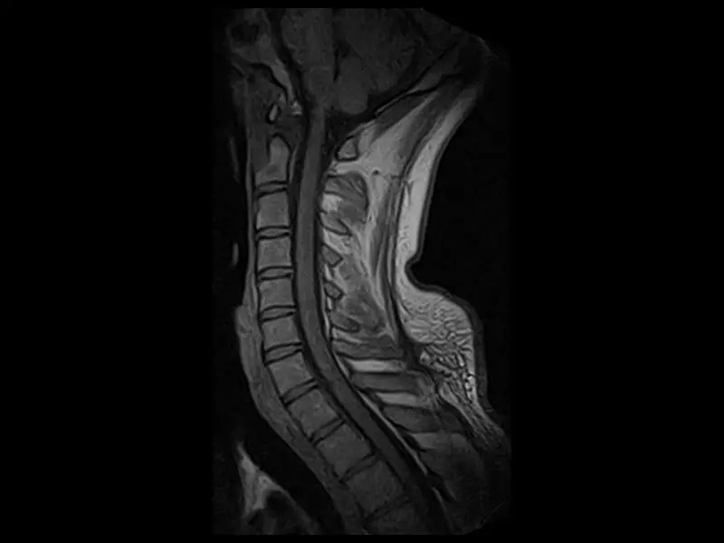 S-scan Open - Cervical Spine Echo Sagittal No exp 4.26