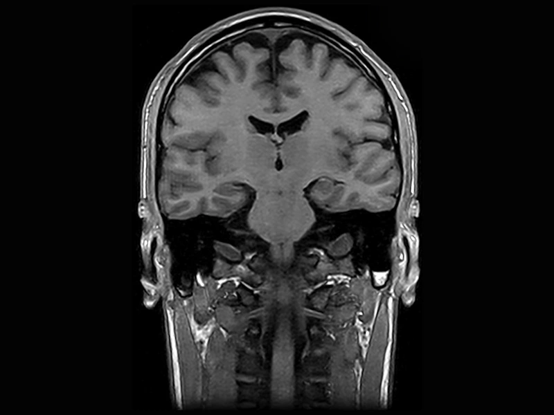 Magnifico™Open - Brain 3D SST1 coronal