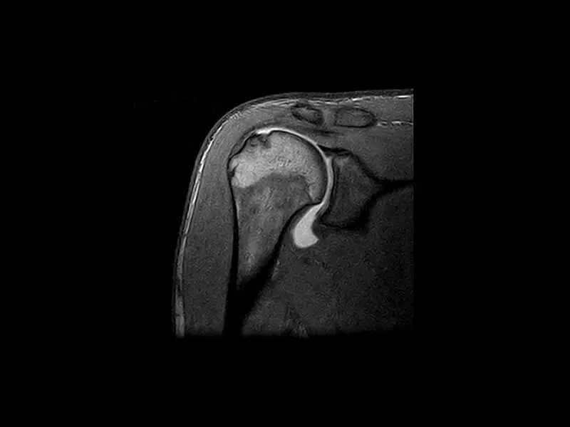 S-scan Open - 3D SHARC artro Cor Shoulder