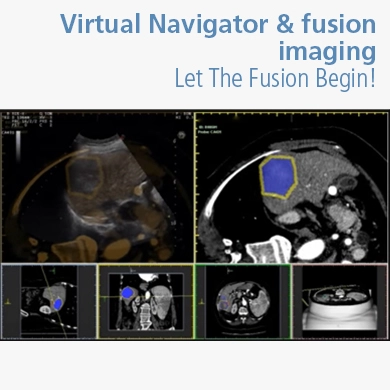 Virtual Navigator & fusion imaging: Let The Fusion Begin!