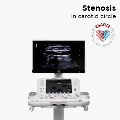 Stenosis in carotid circle