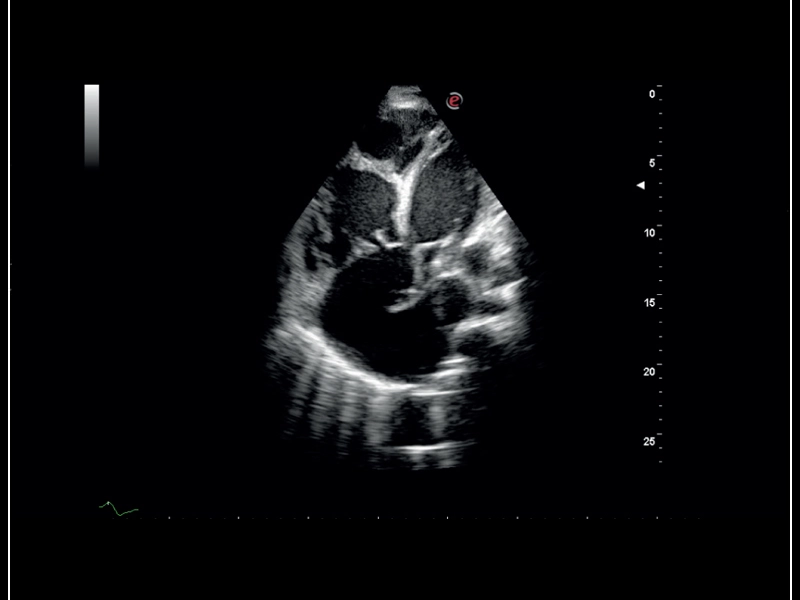 MyLab™Sigma - High definition B-mode cardiac imaging