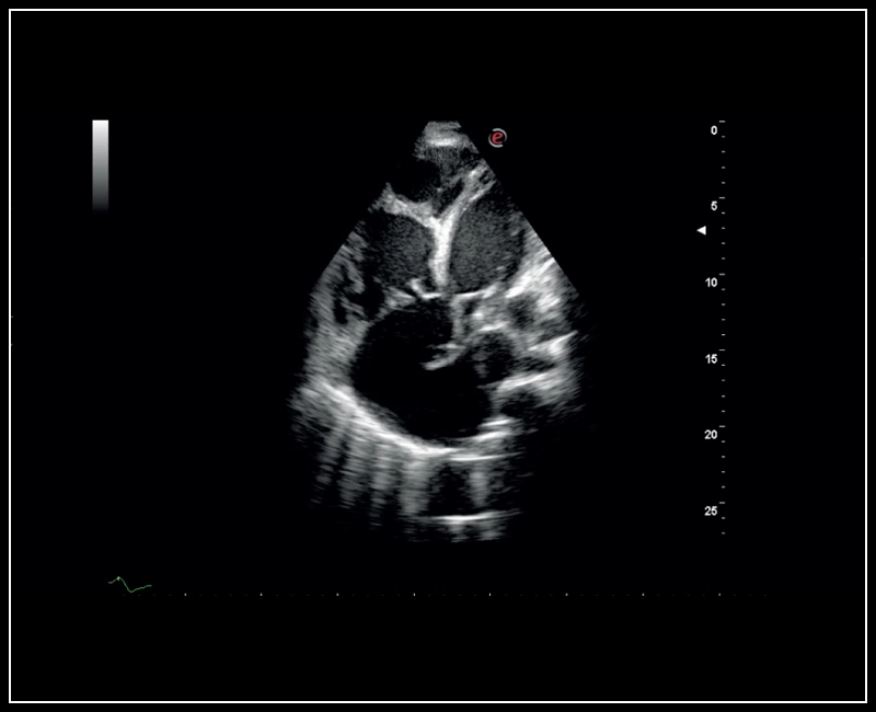 MyLab™Sigma - High definition B-mode cardiac imaging