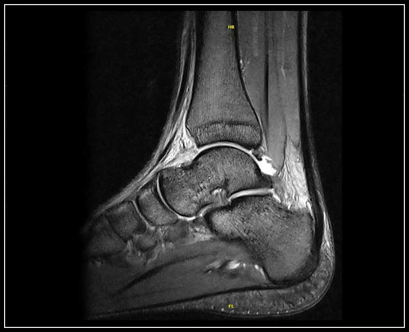 G-scan Brio - Ankle - GE T2 Sagittal