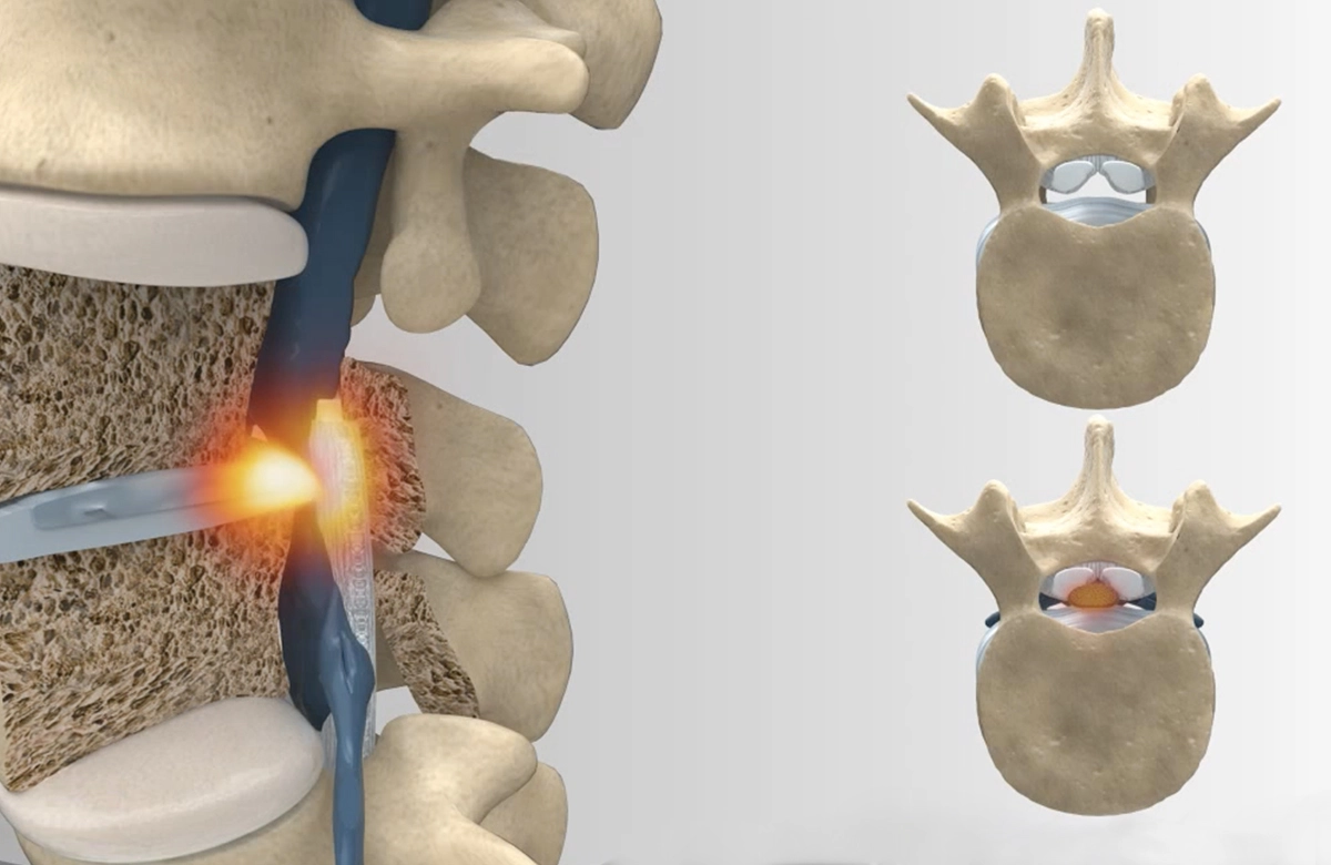 Spine Nevada Minimally Invasive Spine Institute