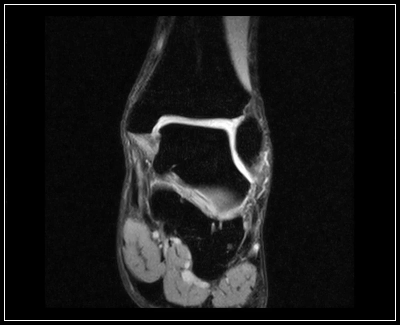 O-scan - Ankle - XBone Coronal