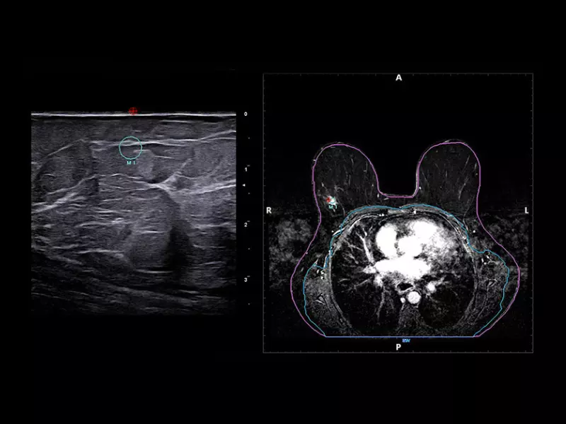 MyLab™X90 - BreastNav™ MRI Automatic segmentation of the breast MRI and real-time fusion based on an adaptive 3D mod