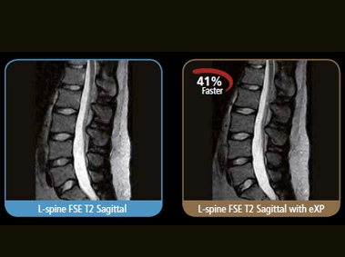 S-scan - L Spine FSE T2 Sagittal with eXP