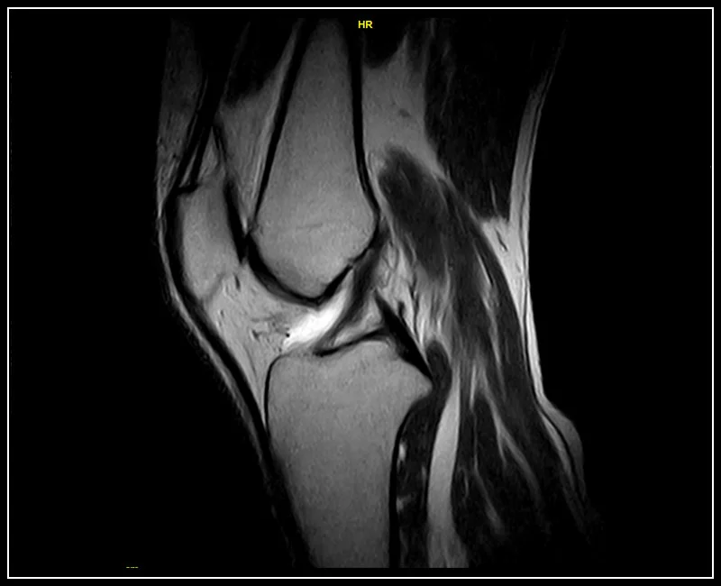 G-scan Brio - Knee - FSE T2 Sagittal