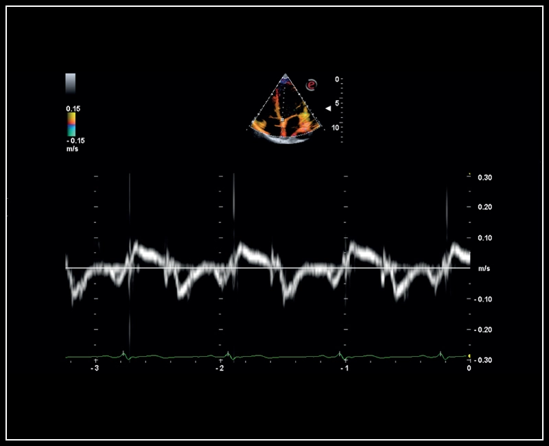 MyLab™Sigma - Mitral valve posterior leaflet analysis with Tissue Velocity Mapping