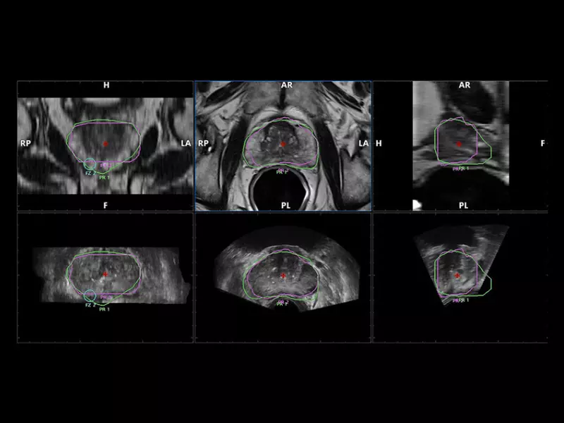 MyLab™X90 - UroFusion Automatic segmentation of the prostate MRI/US, followed by autoregistration of both modalities for targeted biopsies